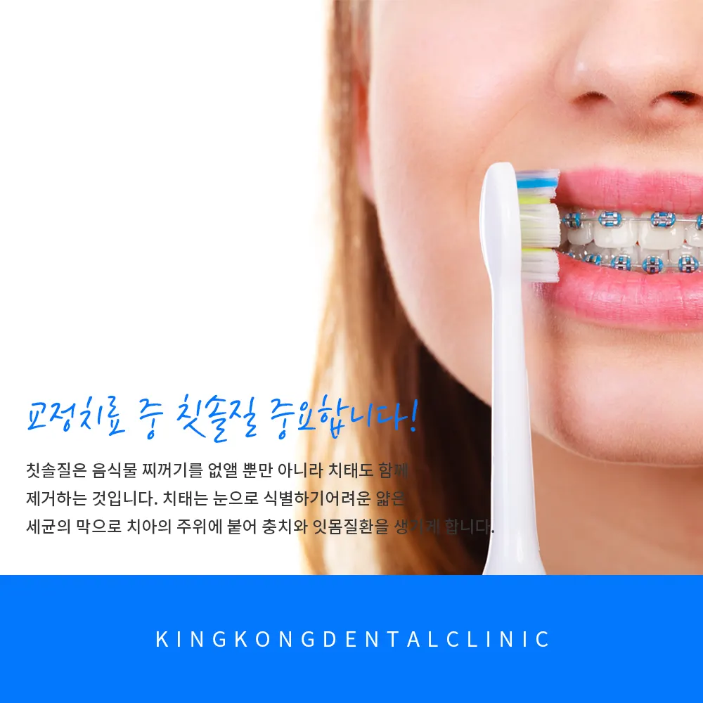교정치료 중 칫솔질 중요합니다^^* — 공지 이미지