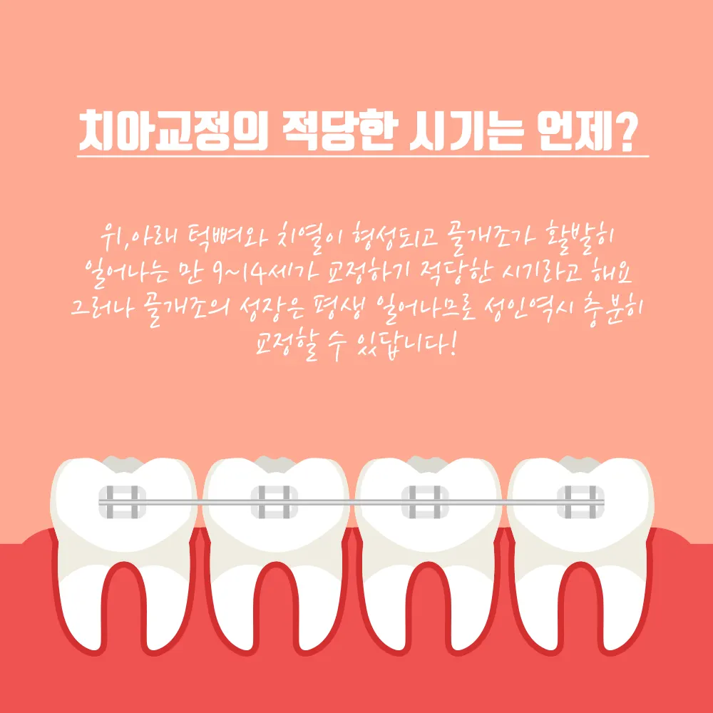 치아교정 이것이 궁금해!!!! — 공지 이미지