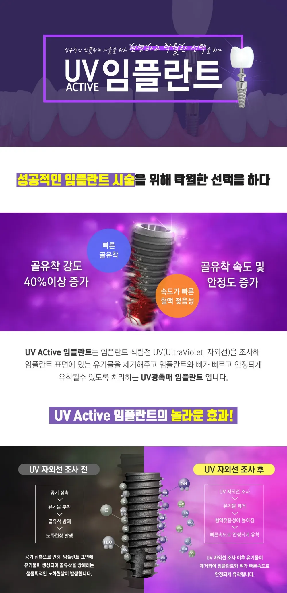 킹콩치과 성공적인 임플란트 시술을 위해 UV임플란트 도입 — 공지 이미지