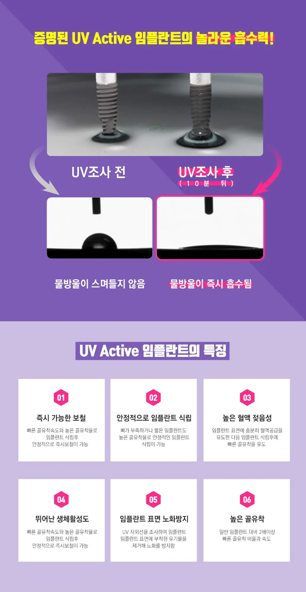 킹콩치과 성공적인 임플란트 시술을 위해 UV임플란트 도입 — 공지 이미지