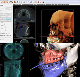 3D CT 진단 프로그램 화면