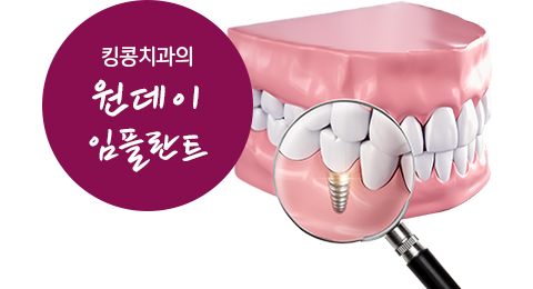 킹콩치과의 원데이 임플란트 — 치아 모형과 돋보기 그림
